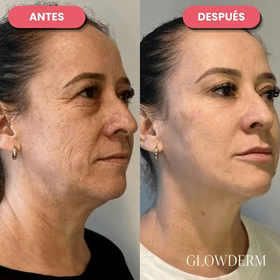 Antes y después de rostro con líneas finas y arrugas reducidas