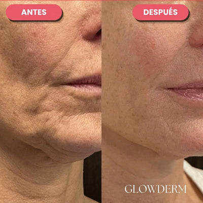 Antes y después de piel opaca a una piel más pareja y luminosa