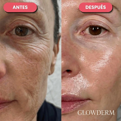 Antes y después de piel con poros más visibles a una piel más lisa